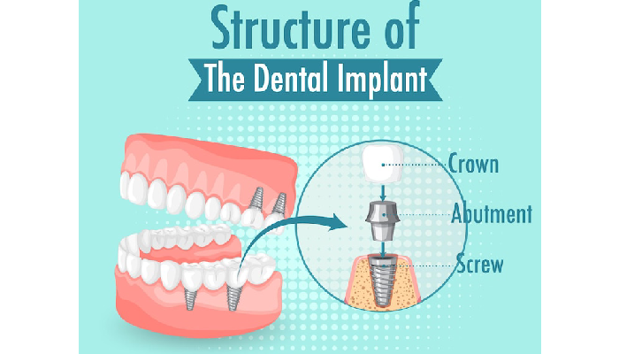 all-on-x dental implants pembroke pines